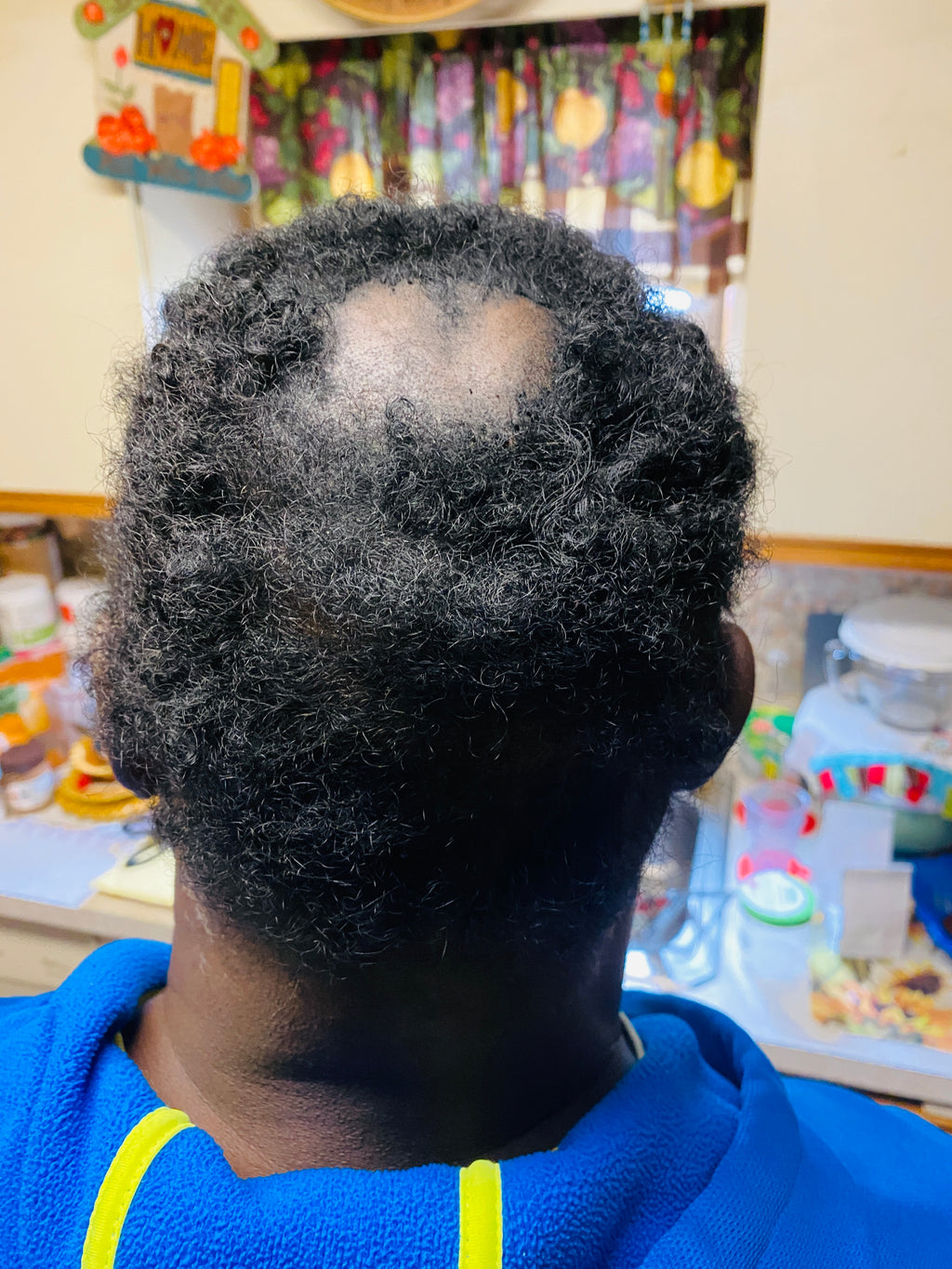 Strong Hair Follicle Stimulator